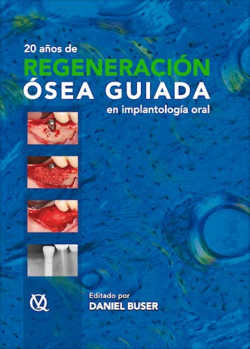 Portada del libro 9788489873490 20 Años de Regeneración Ósea Guiada en Implantología Oral