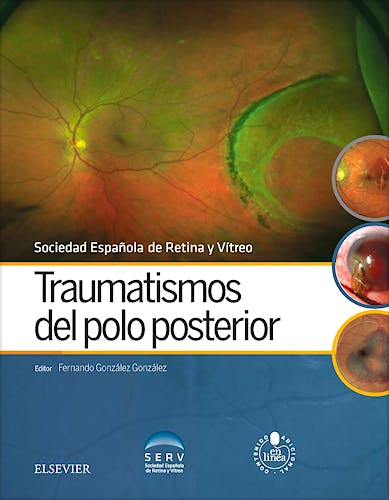 Portada del libro 9788491130529 Traumatismos del Polo Posterior
