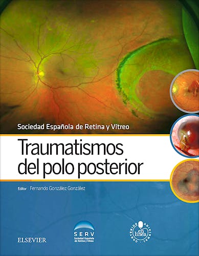 Traumatismos del Polo Posterior