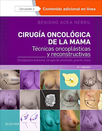 Cirugía Oncológica de la Mama. Técnicas Oncoplásticas y Reconstructivas. Oncoplastia Extrema, Cirugía de Precisión, Puerto Único