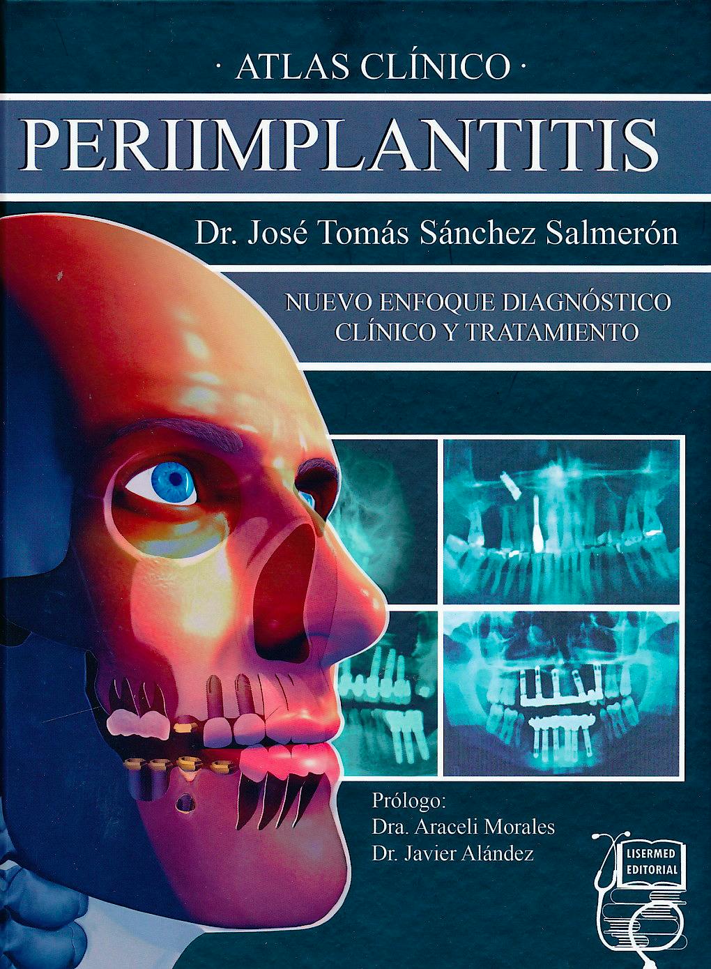 Portada del libro 9788494231803 Atlas Clínico Periimplantitis. Nuevo Enfoque Diagnóstico Clínico y Tratamiento