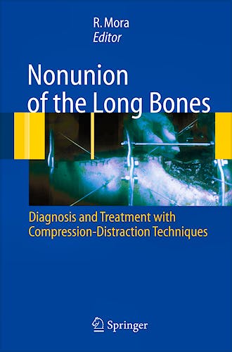 Portada del libro 9788847004085 Nonunion of the Long Bones. Diagnosis and Treatment with Compression-Distraction Techniques