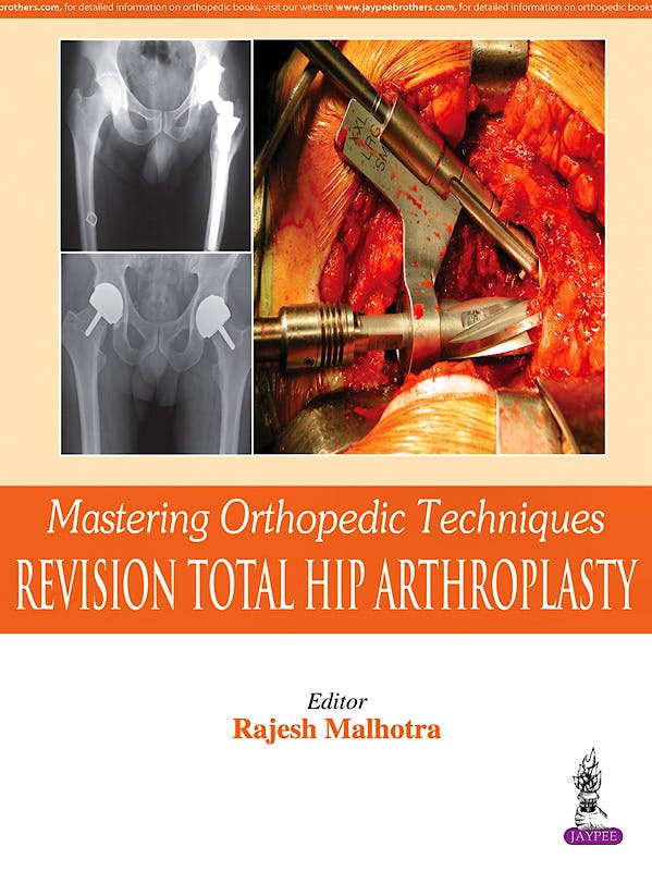 Mastering Orthopedic Techniques. Revision Total Hip Arthroplasty 9789351524861 Malhotra, R