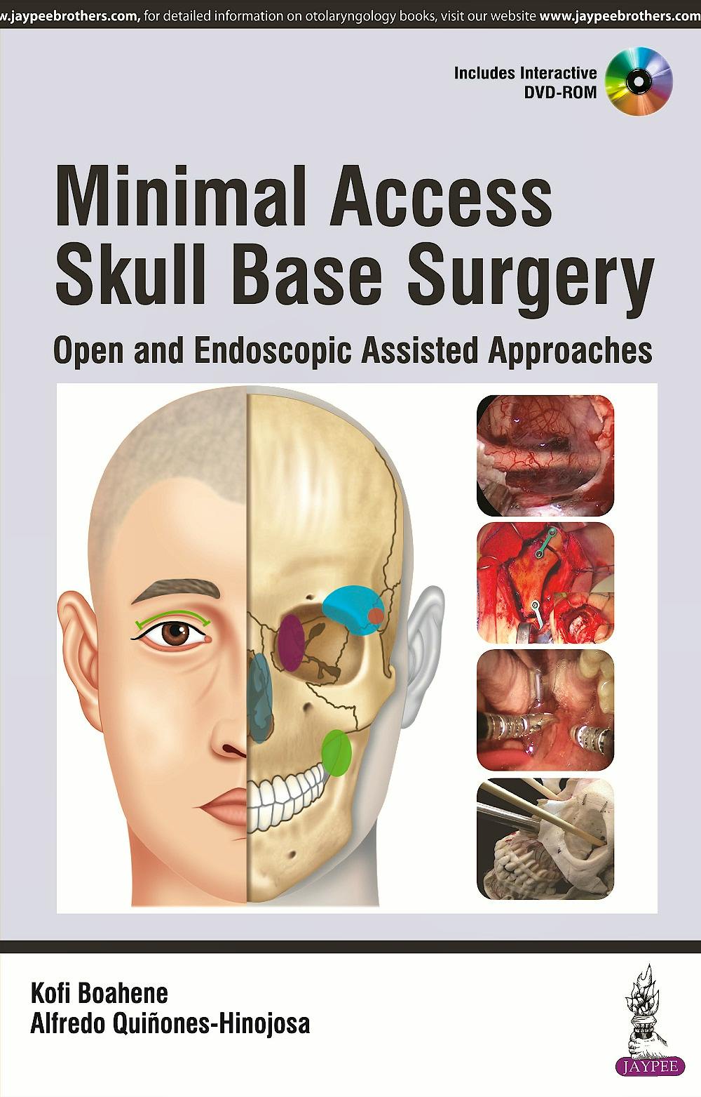 Portada del libro 9789351529347 Minimal Access Skull Base Surgery. Open and Endoscopic Assisted Approaches + DVD-ROM