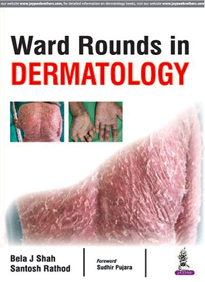 Portada del libro 9789386322685 Ward Rounds in Dermatology