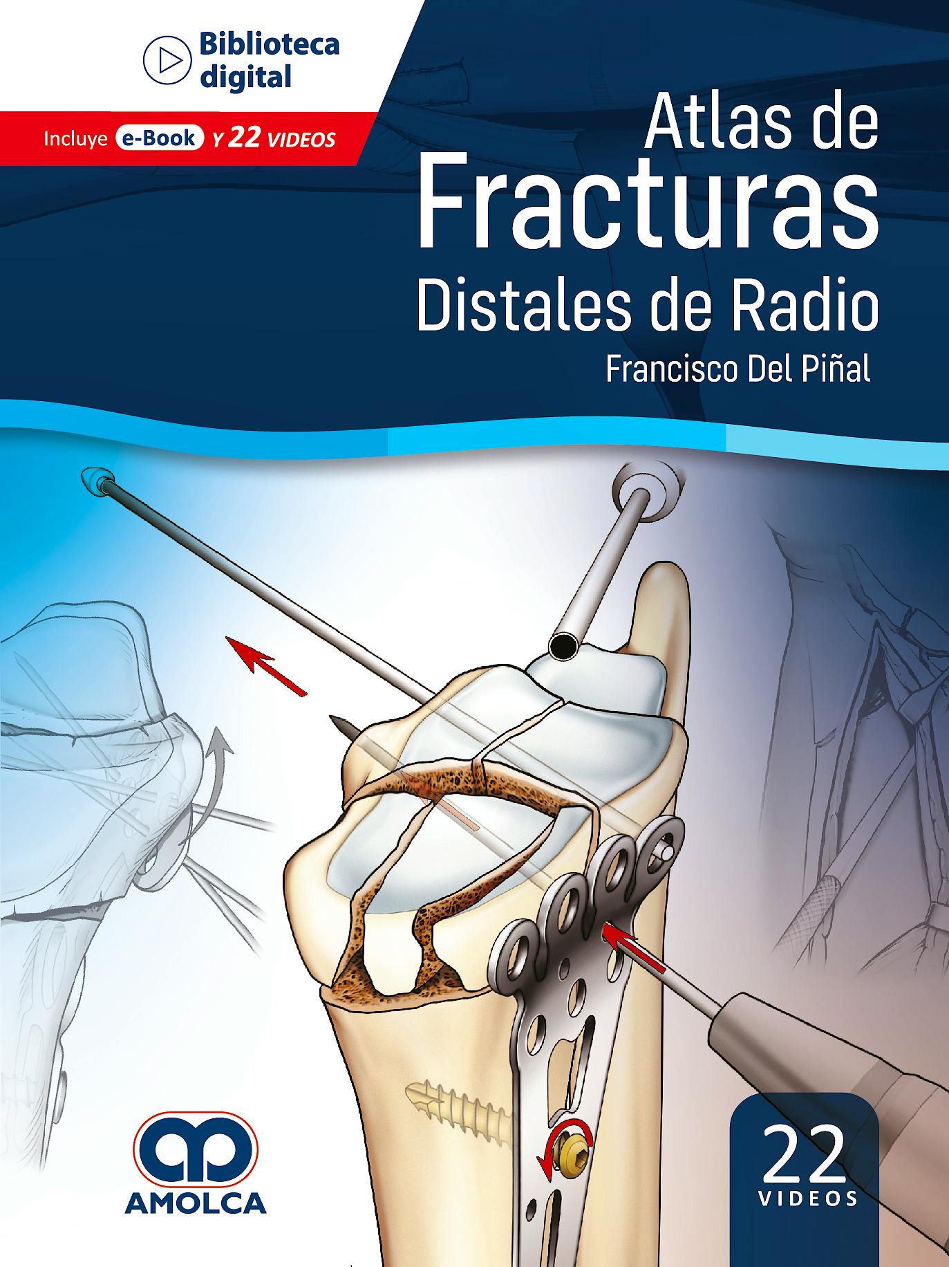 Portada del libro 9789585348790 Atlas de Fracturas Distales de Radio