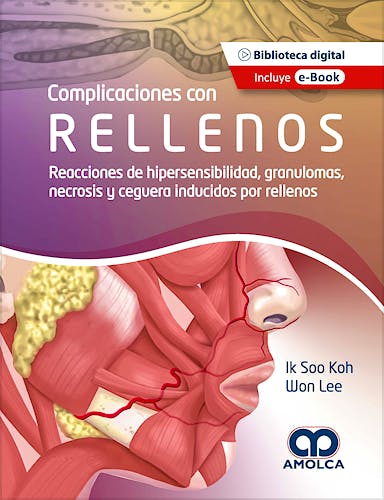 Portada del libro 9789585349001 Complicaciones con Rellenos. Reacciones de Hipersensibilidad, Granulomas, Necrosis y Ceguera Inducidos por Rellenos