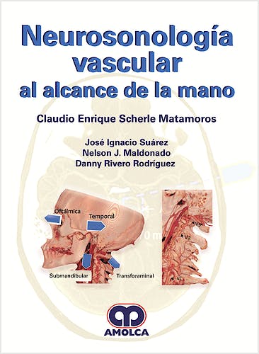 Portada del libro 9789585426535 Neurosonología Vascular al Alcance de la Mano