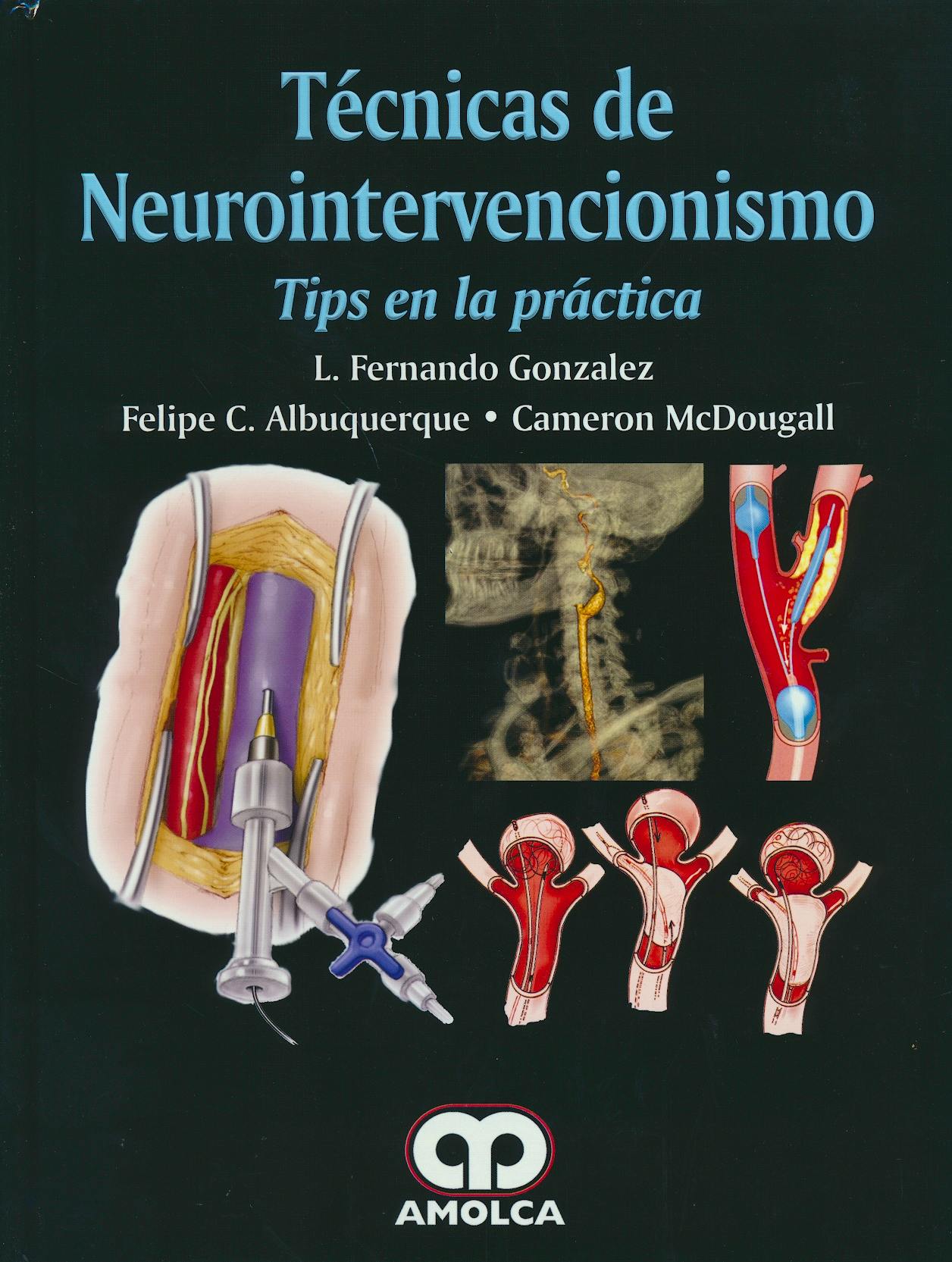 Técnicas De Neurointervencionismo. Tips En La Práctica