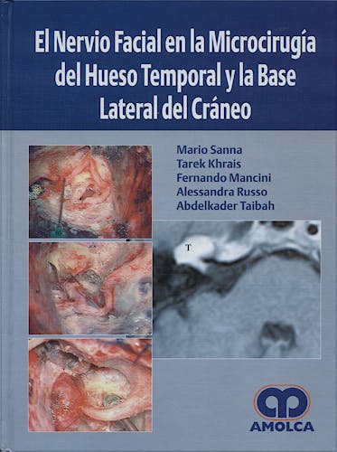 Portada del libro 9789588328560 El Nervio Facial en la Microcirugia del Hueso Temporal y la Base Lateral del Craneo