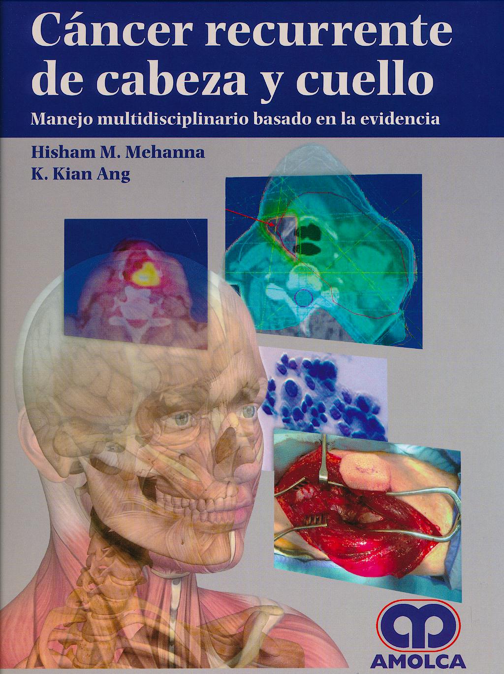 Portada del libro 9789588816623 Cáncer Recurrente de Cabeza y Cuello. Manejo Multidisciplinario Basado en la Evidencia