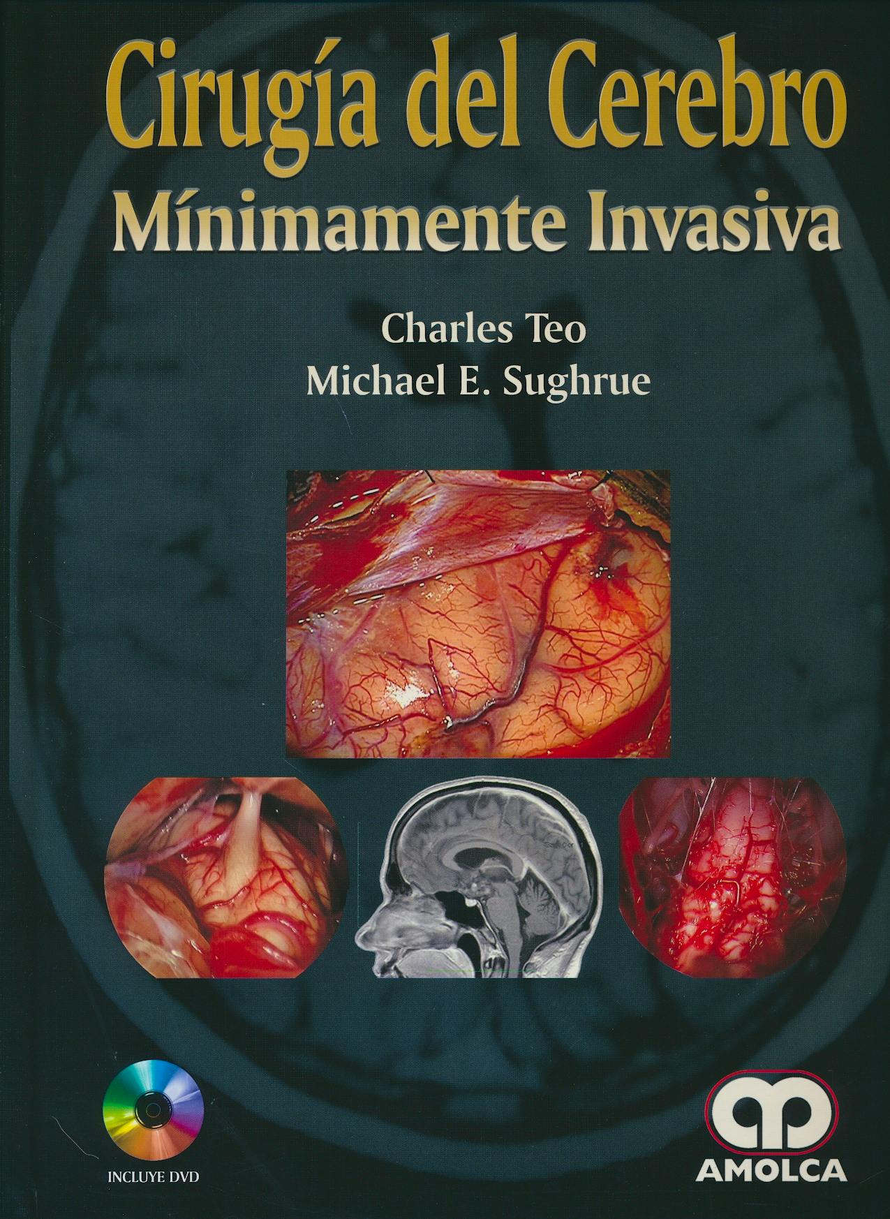 Portada del libro 9789588950273 Cirugía del Cerebro Mínimamente Invasiva + DVD