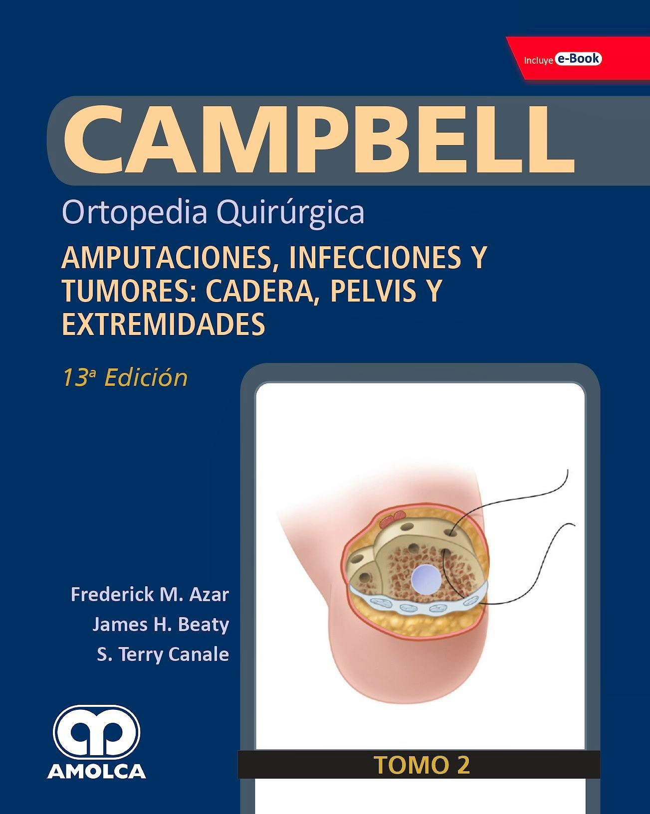 Portada del libro 9789804300905 CAMPBELL Ortopedia Quirúrgica, Tomo 2: Amputaciones, Infecciones y Tumores, Cadera, Pelvis y Extremidades