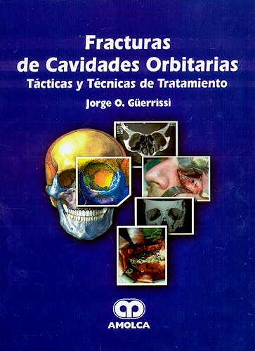 Portada del libro 9789806574359 Fracturas de Cavidades Orbitarias. Tácticas y Técnicas de Tratamiento
