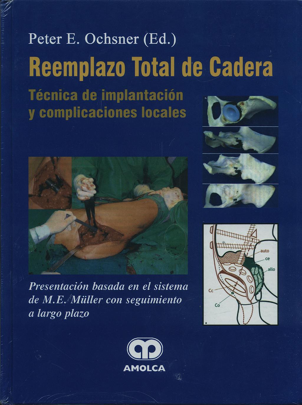 Portada del libro 9789806574540 Reemplazo Total de Cadera. Técnica de Implantación y Complicaciones Locales