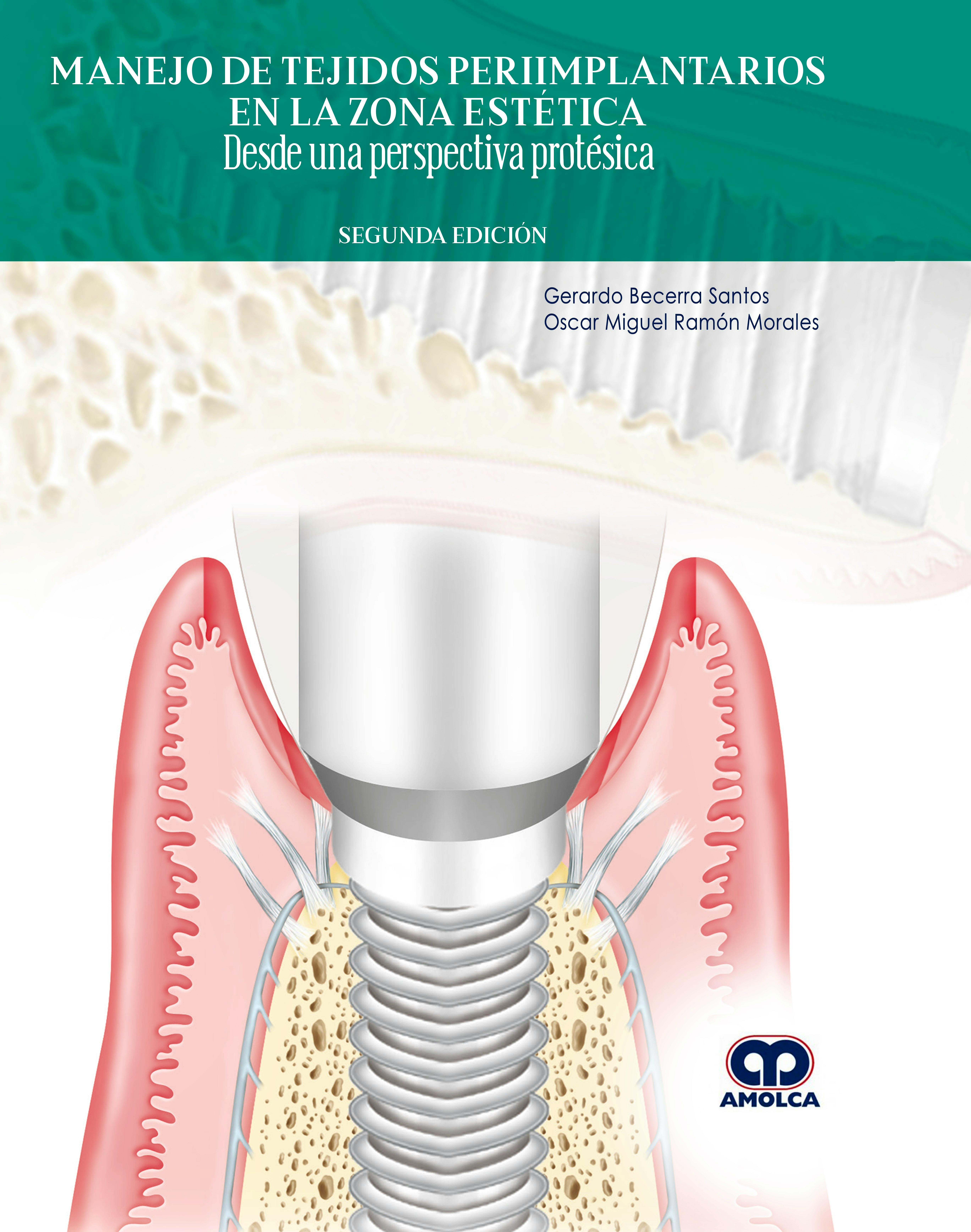 Manejo De Tejidos Periimplantarios En La Zona Estética. Desde Una ...