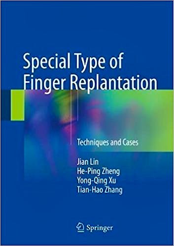 Special Type of Finger Replantation. Techniques and Cases