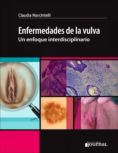 Enfermedades de la Vulva. Un Enfoque Interdisciplinario