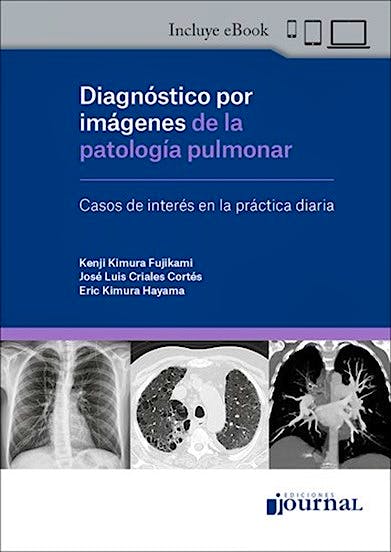 Müller's Imaging of the Chest (Expert Radiology Series) (Print and Online)